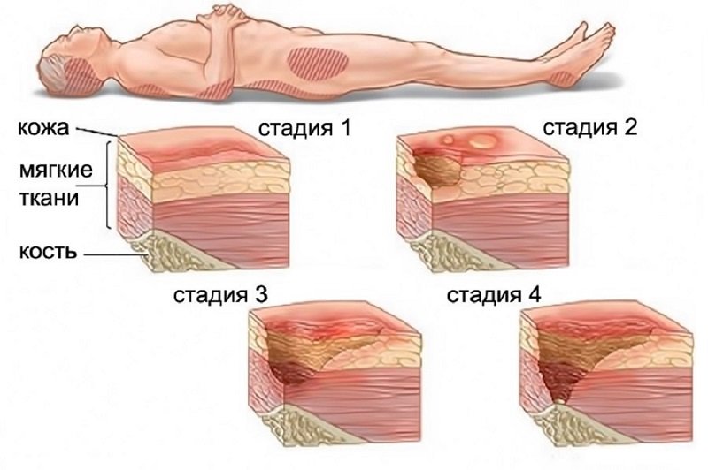 _и лечение пролежней 1.....jpg