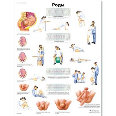 Медицинский плакат "Роды"