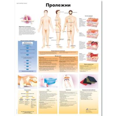 Медицинский плакат "Пролежни"