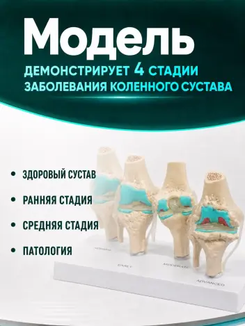 Анатомическая модель коленного сустава макет заболевания суставов Retorsa